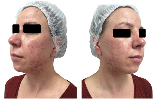 Figure 1 Clinical case of acne in an adult woman - 37-year-old normoandrogenic patient with moderate acne on the face and neck associated with dyschromia.