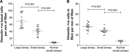 Figure 6 (A) Comparison of number of basal epithelial cells positive for vimentin in CAL large airway versus CAL small airways and in normal control small airway. (B) Comparison of number of vimentin-positive cells in Rbm in CAL large airway versus CAL small airway and normal control small airway.Abbreviations: CAL, chronic airflow limitation; Rbm, reticular basement membrane.