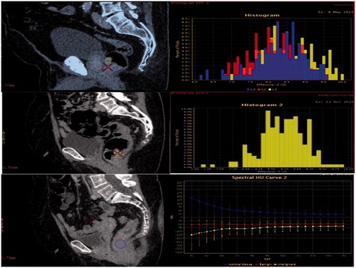 Figure 1. DECT scan demonstrating histogram of effective-z values obtained from monochromatic images at 70 KeV. The top left image is from a malignant tumor with its corresponding effective-z histogram. Middle left is from a benign tumor with its corresponding effective-z histogram. Bottom left is from normal bowel tissue, bottom right shows line graphs for malignant, benign and normal tissue illustrating the difference in HU values at different energy levels in monochromatic images. Circular Roi’s are drawn as large as possible to cover as much of the tumor as possible.