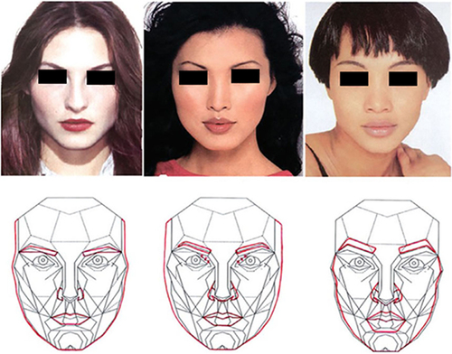 Figure 2 Ethnic variations of the phi mask. Reproduced from Sturm-O’Brien AK, Brissett AE, Brissett AE. Ethnic trends in facial plastic surgery. Facial plastic surgery: FPS. 2010;26(2):69–74. © Georg Thieme Verlag KG.Citation18