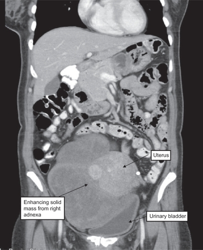 Figure 1 Fifty-year-old female presented with a palpable mass in the lower abdomen. Oral and IV contrast enhanced CT revealed 10 cm heterogeneously enhancing solid mass arising from right adnexa.