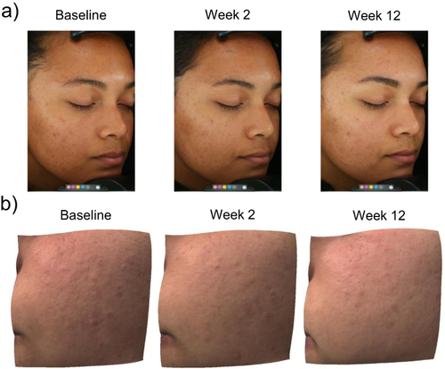 Figure 5 Improvements observed in acne-prone/oily skin after 12 weeks of DGR. The participant pictured was a 22-year-old woman with Fitzpatrick Skin Type IV. (a) Photographs under Standard lighting showing improvements in skin texture and skin tone unevenness. (b) 3D images showing visible improvements in skin texture and blemish appearance.