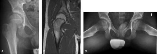 Figure 1. Case 1. The typical coxa valga due to coalescence (arrow) on a standard AP view (A) and T1-weighted coronal MRI of the pelvis during growth at the age of 13 years (B). On the Lauenstein view, the head-neck offset is small (C).