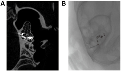 Figure 2 Micro CT images after CI in guinea pigs: (A) Sagittal plane of the left cochlea. The electrode array occupied the whole of the first turn and part of the second turn; (B) Fluoroscopic imaging of the left temporal bone. There was no folding of the electrode array in the cochlea.