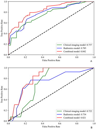 Figure 4. Receiver operating characteristic (ROC) curves of the clinical-imaging mode, radiomics model and combined model in the training (A) and validation (B) cohorts.