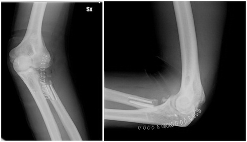 Figure 4. Prosthetic removal.