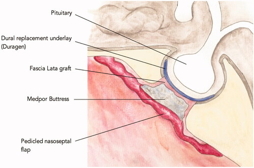 Figure 1. This image illustrates an example method by which the anterior skull base may be repaired following transsphenoidal surgery.