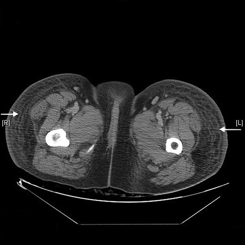 Figure 1.  Computed tomography showing increased attenuation of the subcutaneous fat over both the thighs (arrows).