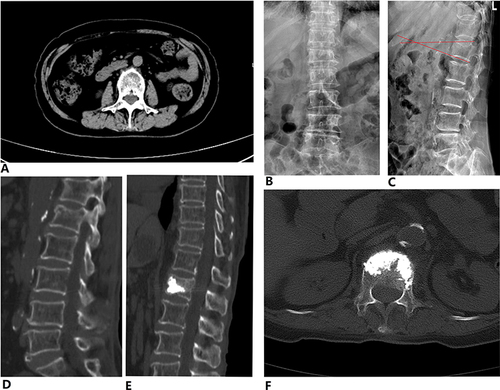 Figure 1 An 84-year OVCF female patient with sarcopenia treated with PKP. (A) the CT scan at the level of third lumbar vertebrae, (B–D) the preoperative X-ray and CT-scan showed L1 compression fracture, and the AH is 66.1%, LKA is 16.4°(Red arrows: Cobb angle between the superior and inferior aspect of the fractured vertebra). (E and F) the post-operative CT scan showed the post-operative AH is 93.1% and LKA is 6.3°.