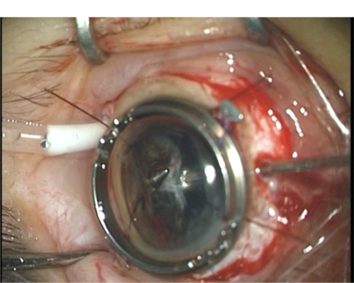 Figure 1 Intraoperative photograph of Case 1 with AHFVP undergoing membrane removal with vitreous cutter.