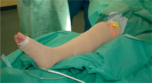 Figure 2. The compression bandage