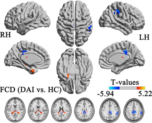 Figure 3 Areas with significantly different functional connectivity density in the typical frequency band (0.01–0.08 Hz) between patients with diffuse axonal injury and healthy controls.