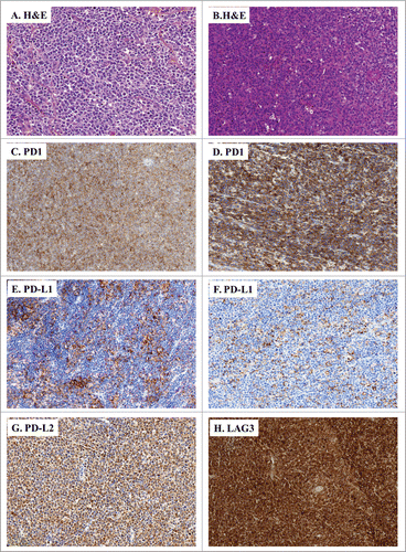 Figure 3. IHC of immune escape markers expressed by DLBCL. (A and B) Classical H&E stainings of DLBCL biopsies (A: ×200, B: ×100) reveal large-sized and atypical lymphoid cells harbouring a round nucleus and an irregular membrane. (C–H) Representative IHC of DLBCL samples stained for: PD-1 (C: ×100, D: ×200); PD-L1 (E: ×100, F: ×150), PD-L2 (G: ×100), and LAG3 (H: ×100).