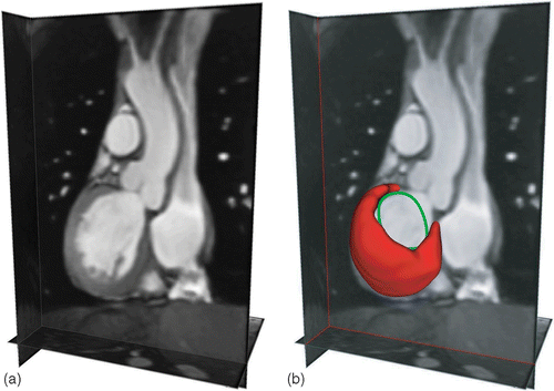 Figure 3. a) Image of the prior high-resolution average heart model at mid-diastole (MD). b) Prior model at mid-diastole showing two segmented features of interest: the left ventricle surface and the mitral valve annulus. [Color version available online.]