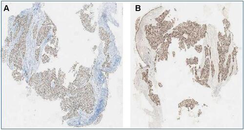 Figure 1 Pulmonary tumor squamous cell histology analysis. (A) P40 immuno- histochemistry stain, 20×; (B) P63 immunohistochemistry stain, 20× magnification demonstrating squamous differentiation.