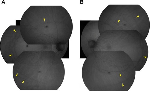 Figure 3 Fundus autofluorescence of the right (A) and left (B) eyes.