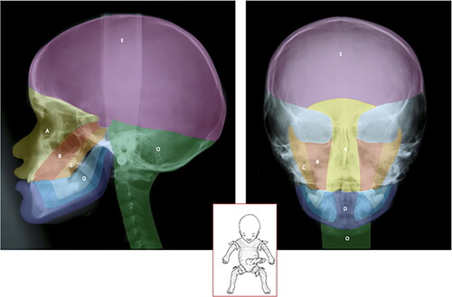 Figure 2. Illustration of the neural crest cells schematically transferred from experimental animals to a radiograph from a child 10 years of age. Left: This figure can be compared to the left drawing in Figure 1. The colors demonstrate different fields. The yellow is the frontonasal field (A). The red is the maxillary field (B). The orange is the palatine field (C). The blue color (D) is the mandibular field. Not formed by neural crest cells are the theca field in purple (E) and the occipital field in green (O). The occipital field arises, like the vertebral bodies, from cartilage, influenced by the notochord. Right: This figure indicates the anterior view of the cranium. The colors and letters are comparable to the colors and letters in the left figure. Inserted figure between the left and right: This drawing indicates the well-known developmental fields marked by body lines. For a long time, the developmental fields in the head were not known (absence of lines) The neural crest cell migration in different directions explained the cranial development (Le Douarin [Citation12, Citation13]).