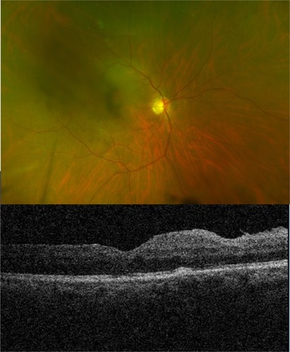 Figure 2 Postoperative fundus color image showing a central haze due to early cataract (top) and OCT image showing maintained foveal contour (bottom).