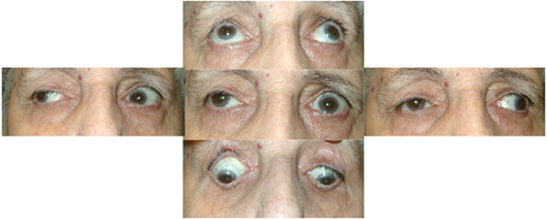 Figure 2 A 73-year-old lady was referred with a history of diplopia. Examination shows right ptosis and left upper lid retraction (Hering’s law). She had a bilateral adduction deficit (pseudo-bilateral internuclear ophthalmoplegia). MRI of the brain was normal, the ice test was positive, and she had positive AchR-antibodies.