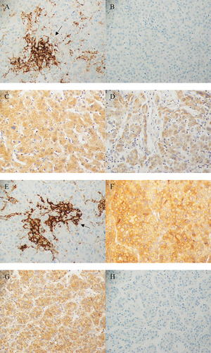 Figure 1 The expression of PD-L1 and IDO detected by immunohistochemical staining. Representative images of immunohistochemical staining of PD-L1 and IDO in HCC cases: (A) Positive strong membranous PD-L1 staining in tumor cells with high PD-L1 expression indicated by black arrow. (B) Negative PD-L1 expression. (C) Strong diffuse high cytoplasmic IDO expression. (D) Weak patchy low cytoplasmic IDO expression. (E and F) High PD-L1 and IDO expression in the same tissue specimen respectively. (G and H) IDO+ and negative PD-L1- in the same tissue specimen respectively. All images were captured at 40X magnification.