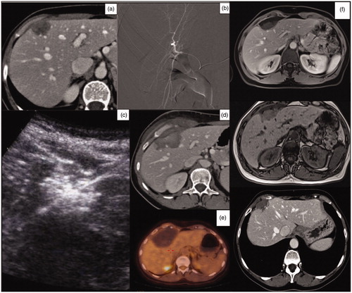 Figure 2. (a) Axial pretreatment post-contrast CT exam of a 54-year-old woman, showing a polilobated hypoenhancing colon cancer metastasis in segment IV. (b) Superselective angiography through the right femoral artery. A subsequent post-contrast ultrasound scan confirmed the artery network; embolization was performed by administering 75 μm Embozene particles. (c) Ultrasonographic monitoring of the subsequent MWA treatment. (d) Post-treatment axial CT-image control, showing a large area of necrosis. (e) PET-CT performed at 1 year showing no pathologic uptake in the treated area. (f) MRI-image control at 1-year and post-contrast CT scan at 2 years showing a decrease in the necrotic area.