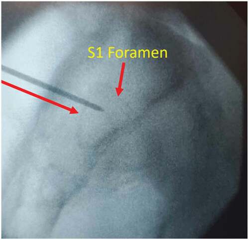 Figure 2. Optimal placement of guide pin in lateral view.