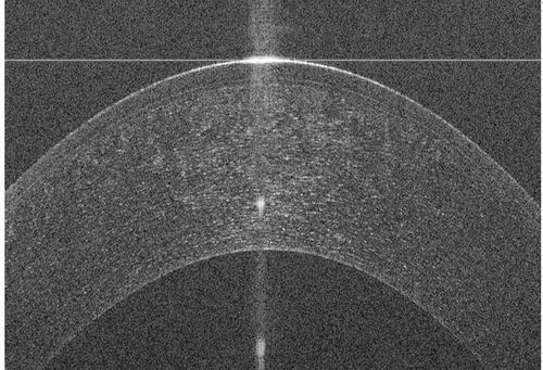 Figure 1 Anterior segment optical coherence tomography of a healthy cornea using an HD-OCT (Envisu R2210, Bioptigen, Leica, Buffalo Grove, IL, USA) collected at the Bascom Palmer Eye Institute.