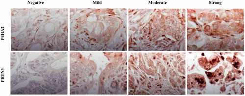Figure 1. Representative immunohistochemical images of P4HA2 and PRTN3 expressions in pancreatic cancer.