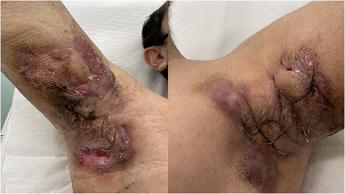 Figure 1 Secukinumab therapy. Before initiation of secukinumab therapy.