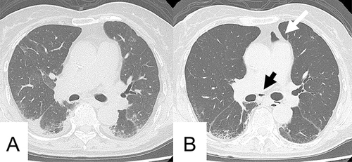 Figure 1 Computed tomography (CT) images of the chest of a 75-year-old woman with systemic lupus erythematosus and Sjogren syndrome. CT performed at admission revealed consolidation and reticular opacities in peripheral areas of both lungs (A). A CT scan performed 1 month later revealed the appearance of gas density in the anterior mediastinum (white arrow) and around the carina (black arrow) (B). The width of the anterior mediastinum decreased owing to weight loss.