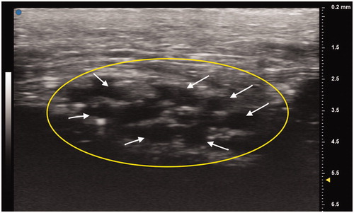 Figure 2. Patient’s unaffected left median nerve at the wrist crease. Oval indicates cross section of the median nerve. White arrows point to individual nerve fascicles.