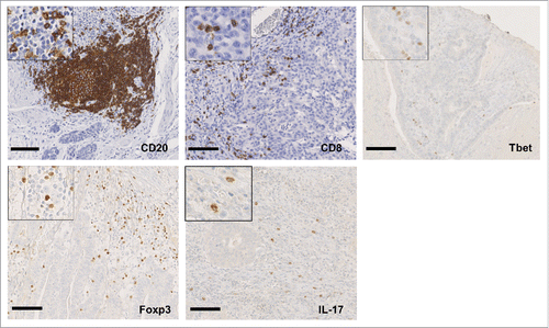 Figure 1. Immune infiltrates in human gastric cancer. Representative immunohistochemical stainings of CD20+, CD8+, Tbet+, Foxp3+ and IL-17+ lymphocytes infiltrating gastric cancer. Scale bar indicates 100 µm.