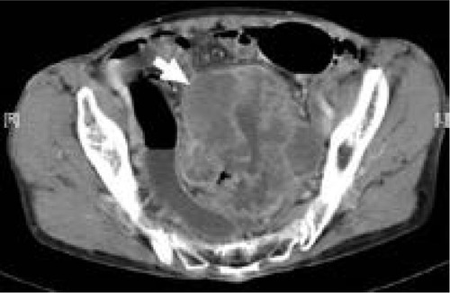 Figure 6 Computed tomography scan of 69-year-old woman with mucinous carcinoma in descending colon.
