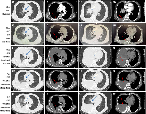 Figure 1 Computed tomography scans showing clinical response to treatments. (A–D) Computed tomography scan of lesions and pleural effusion at baseline. (E–H) The patient achieved partial remission after crizotinib treatment. (I–L) PD with mass enlargement and increased pleural effusion. (M–P) Three months after half-dose crizotinib treatment, the patient achieved SD, (Q–T) which was maintained for more than 9 months. Blue arrows indicate lesions, and red arrows indicate pleural effusion.