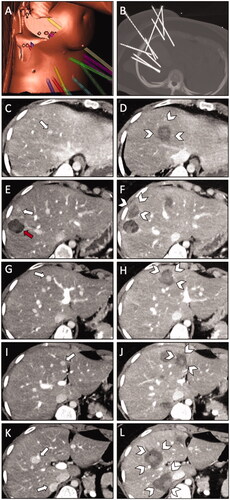 Figure 2. The second ablation session (of three) with simultaneous ablation of six HCAs in a 29-year-old woman with hepatocellular adenomatosis (β-Catenin positive) referred for SRFA. (A) Screenshot of the navigation system with a 3D reconstruction of the planning CT scan with nine planned trajectories. (B) MIP of the non-enhanced control CT-scan depicting all nine coaxial needles in place. (C,E,G,I,K) Pre-interventional CT scan in the late arterial phase shows a total of six HCAs (white arrows). Note the coagulation zone of a previous ablation, 22 months earlier (red arrow in E). (D,F,H,J,L) Post-interventional CT-scan in portal venous phase with corresponding coagulation zones (white arrowheads).