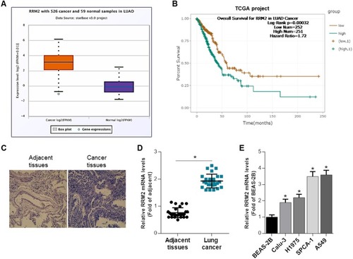 Figure 1 RRM2 expression is upregulated in NSCLC tissues and cell lines. (A) Relative RRM2 expression level in lung adenocarcinoma patients (N = 526) was remarkably higher than normal controls (N = 59). (B) The TCGA database demonstrated that RRM2 expression was associated with overall survival of NSCLC patients. (C) Representative images of HE stain of cancer tissues and adjacent tissues from the NSCLC patients. (D) The mRNA level of RRM2 in cancer tissues and adjacent tissues from NSCLC patients was examined using RT-qPCR analysis. *P<0.05 vs adjacent tissues. (E) The mRNA expression of RRM2 in 4 NSCLC cell lines and 1 human bronchial epithelial cell line was determined by qRT-PCR, with the BEAS-2B cell line as control. *P<0.05 vs BEAS-2B.
