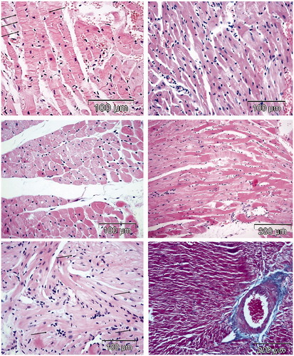 Figure 5. Histomorphological changes in the hearts of two rats treated with HPMA copolymer–DOX conjugate (HE and Masson’s Trichrome stain). Two rats treated with HPMA–DOX showed signs of cardiotoxicity: contraction band necrosis (upper left micrograph), diffuse interstitial infiltrate (lymphocytes and fibroblasts), focal necrosis (upper right micrograph), mild vacuolar degeneration of cardiomyocytes (left middle micrograph), loss of cross striation (middle right micrograph), vacuolar degeneration of cardyomyocites (lower micrograph on the left) and perivascular and interstitial fibrosis (right bottom micrograph Masson’s Trichrome staining).