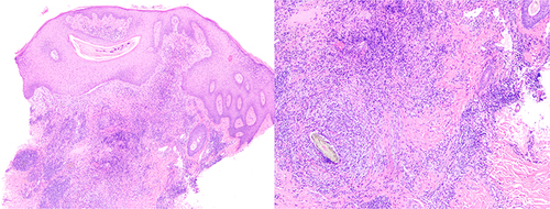 Figure 2 Hematoxylinand eosin stain of biopsy of nape lesion of a patient 1 with CVG and widespread AKN revealed: a nodular collection of acute and chronic inflammation with a foreign body giant cell reaction surrounding keratinaceous debris associated with a scar consistent with a diagnosis of AKN.KN plaques and masses.