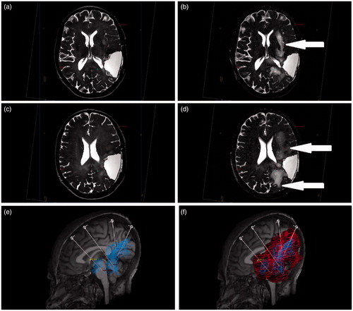 Figure 3. The volume of T2 hyperintensity on real-time MRI scans was used as a proxy measure of drug distribution. Pre-infusion (a and c) and post-infusion (b and d) T2-weighted images were overlaid using neuro | inspire™ stereotactic software and profiles drawn around areas of new T2 hyperintensities (arrows, b and d). The total volume of T2 signal change on completion of the infusions was measured as 97.6 ml. Analysis of contrast enhancement on T1-weighted MRI was used to determine response to CED. Prior to catheter implantation, a total volume of 42.6 ml of tumor enhancement was measured (e; blue). By superimposing the volume of T2 signal change (red) onto the volume of tumor enhancement on T1-weighted imaging (blue), it was possible to ensure drug distribution was achieved throughout the targeted tumor volume as well as the infiltrated peri-tumoral penumbra (f). (Colour online). Please refer to online colour images.