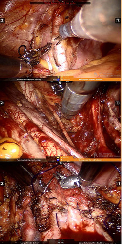 Figure 4 Absorbable continuous locking sutures were used to close the umbilicus fascia and subcutaneous layer with 2-0 and 4-0 Vicryl sutures.
