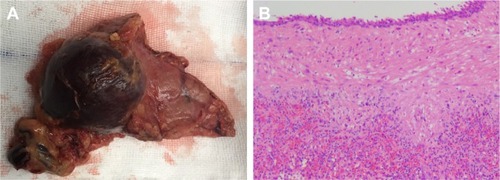 Figure 2 (A) Gross appearance of the epidermoid cyst in an intrapancreatic accessory spleen (ECIPAS), with 4 cm at its greatest diameter. (B) Microscopic analysis revealed a multilocular cyst surrounded by accessory splenic tissue in the pancreas parenchyma, and the cyst wall showed a thin multilayered squamous epithelium (H&E staining, ×50).