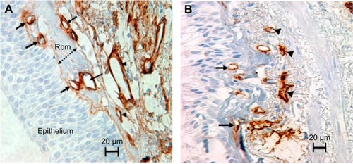 Figure 1 Rbm and LP vessels stained with anti-Collagen IV antibody in (A) and anti-Factor VIII antibody in (B). The epithelium sits on the basement membrane. The thickness of the Rbm, is shown with the two-headed arrow. Vessels are in contact or embedded within the Rbm (arrows). Arrowheads indicate vessels in the lamina propria. Magnification ×400; scale bar =20 µm.