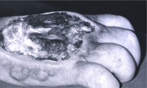 Figure 2 Necrosis after an accidental anthracycline extravasation that was left untreated (before the discovery of dexrazoxane as an antidote).Note: Copyright © 2014 by John Wiley & Sons, Inc. Reproduced from Langer SW. Extravasation reactions. In: Lacouture ME, editor. Dermatologic Principles and Practice in Oncology: Conditions of the Skin, Hair, and Nails in Cancer Patients. John Wiley & Sons Inc. Hoboken, New Jersey; 2014:295–300. All rights reserved.Citation16