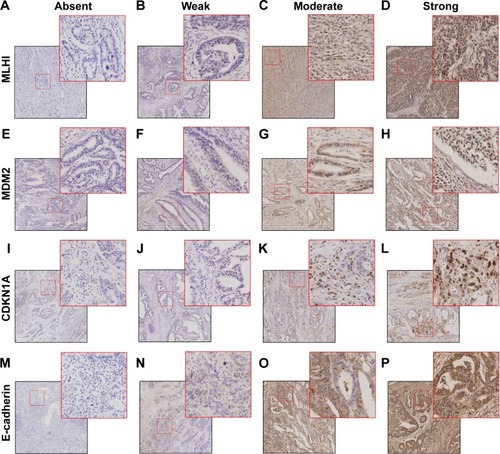 Figure 1 Representative images of multiple markers in EGJ carcinoma.