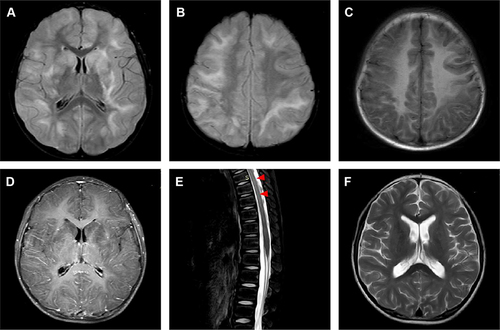 Figure 2 A six-year-old boy diagnosed MOGAD with poor MRI results. Axial T2-weighted fluid-attenuated inversion recovery (A and B) and T1-weighted (C) images of the brain show confluent lesions symmetrically that involve both cortex and white matter, with enhancement (D), as well as the bilateral basal ganglia, thalamus, brainstem, cerebellum (not shown) affected. Sagittal T2-weighted image (E) shows spinal lesions (red arrowheads). After six months, atrophy (F) is observed on T2-weighted image, with multiple residual lesions (not shown).