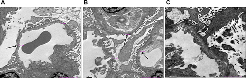 Figure 2 Electron microscopy images of his kidney of IV-6 (A-C) show two glomeruli under electron microscopy. Electron microscopy of renal showed glomerular capillary endothelial cells, renal tubular epithelial cells, and visceral epithelial cells with vacuolar degeneration; segmental fusion of foot processes; irregular with an uneven density of glomerular basement membrane thickness. The black arrow indicates an abnormally thick basement membrane.