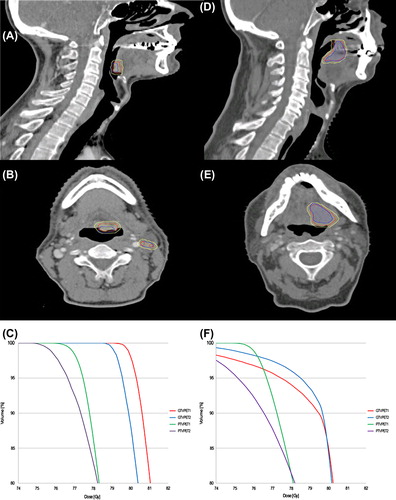 Figure 1. CT slices (sagittal and axial) of the patient with the largest mismatch of 59% (A and B) and of a patient with a mismatch of 18% (D and E). The contours are: GTVPET1 (red), GTVPET2 (blue) and the volume receiving 79 Gy (yellow), converted from the dose color wash. Panels C and F illustrate the DVHs from the same two patients with mismatch of 59% and 18% mismatch, respectively. Curve colors are: GTVPET1 (red), GTVPET2 (blue), PTVPET1 (green), PTVPET2 (purple).