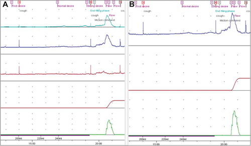 Figure 1. An example of two sets of urodynamic trace for the same patient. (A) Multi-channel trace with Pdet (light blue), Pves (blue), Pabd (red), flow (green). (B) Single-channel Pves trace obtained by removing Pabd.