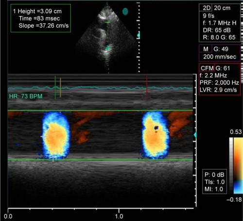 Figure 1 Measurement of color M-mode derived propagation velocity measured along the origin of the descending aorta (AVP).