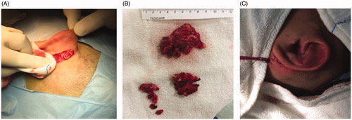 Figure 4. (A, B) A neurofibroma measuring approximately 5 × 4 × 3 cm, exhibited bleeding, lacked a capsule, and showed dense infiltration of the surrounding tissue. The neurofibroma was typical in appearance, resembling a ‘bag of worms’. (C) The external auditory canal after surgery.